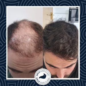 Vergleich - Vor und nach der Haartransplantation