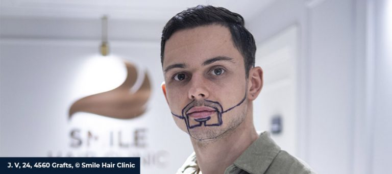 A smile hair clinic patient after beard transplant planning