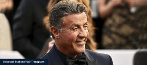 Sylvester Stallone after hair transplant