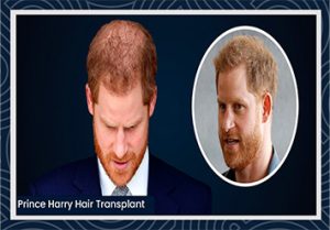 Prince Harry hair transplant before and after