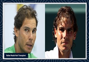 Rafael Nadal Hair transplant before and after