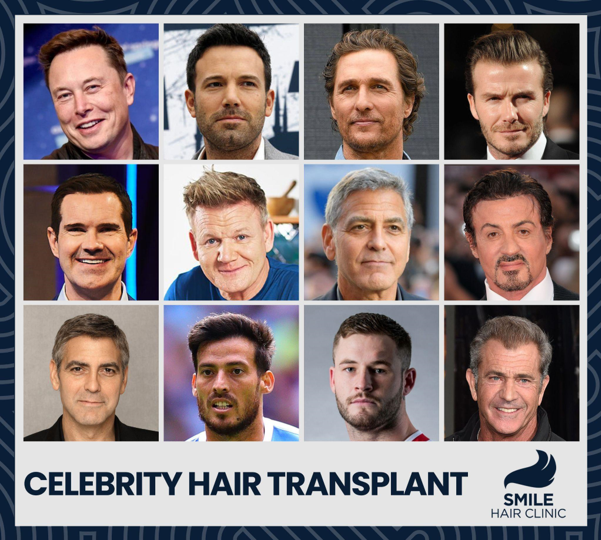 Celebrities Hair Transplants - Smile Hair Clinic
