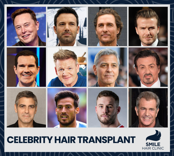 Elon Musk, Ben Affleck, Matthew Mcconaughey, David Beckham, Jimmy Carr, Gordon Ramsay, George Clooney, Sylvester Stallone, David Silva, Zak Hardaker, Mel Gibson after hair transplant photos in collage