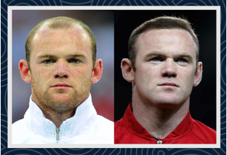 Wayne Rooney hair transplant before and after