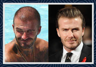 Celebrities Hair Transplants - Smile Hair Clinic Celebrities Hair Transplants - Smile Hair Clinic