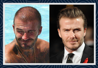 David Beckham hair transplant surgery before and after photos 