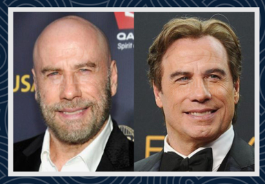 Celebrities Hair Transplants - Smile Hair Clinic Celebrities Hair Transplants - Smile Hair Clinic
