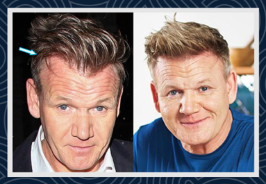 Celebrities Hair Transplants - Smile Hair Clinic Celebrities Hair Transplants - Smile Hair Clinic