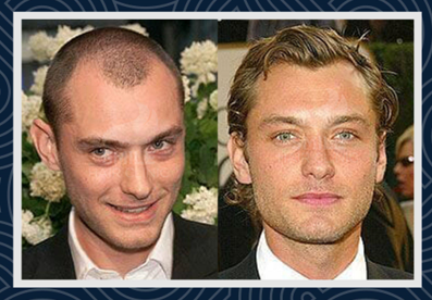 Celebrities Hair Transplants - Smile Hair Clinic