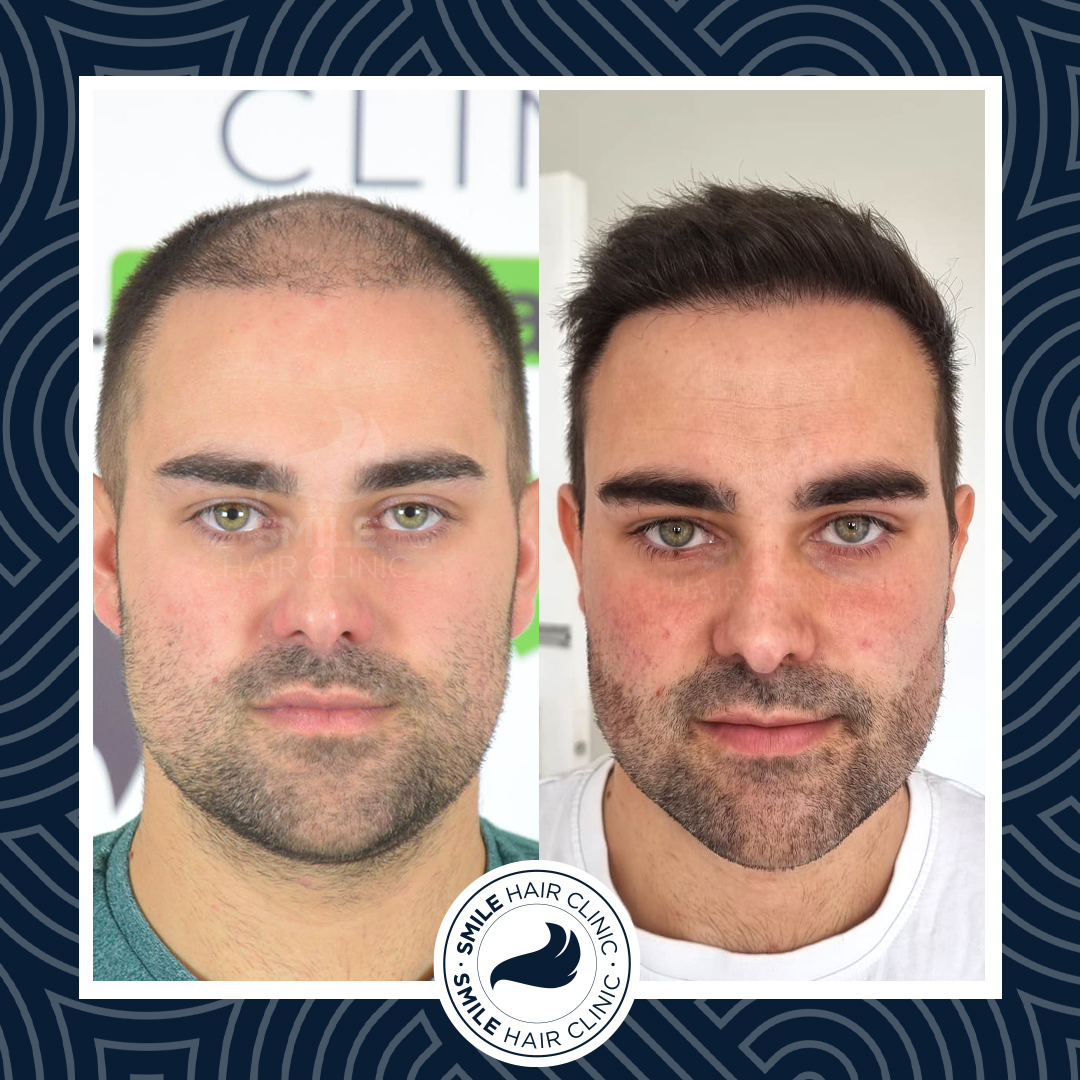 Hair Transplant Turkey Before After - Smile Hair Clinic