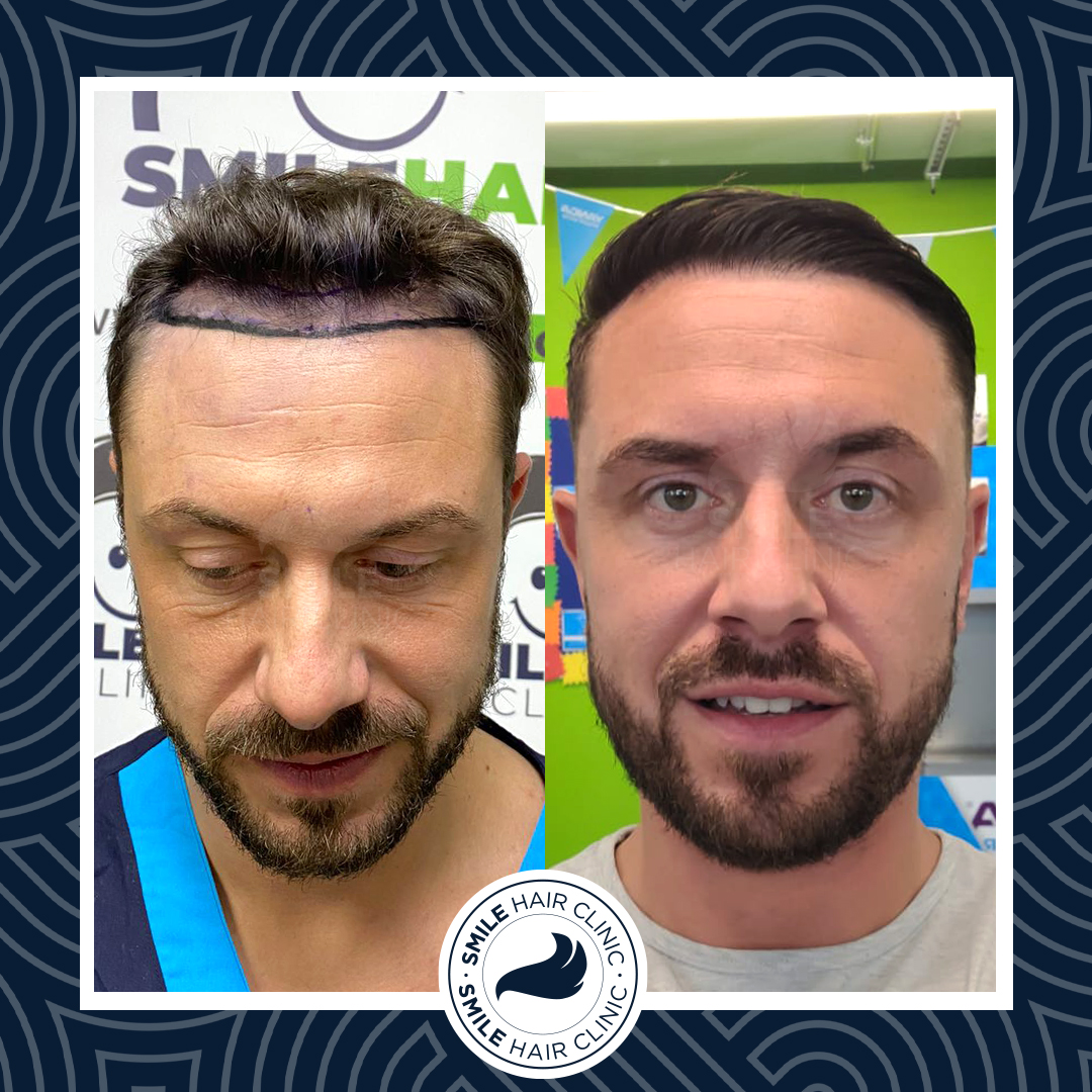 Hair Transplant Turkey Before After - Smile Hair Clinic