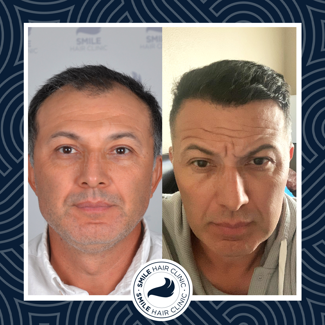 Hair Restoration Gallery  Before After Hair Transplant Photos  Dr Bonaros