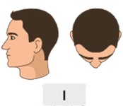 Norwood-hamilton scale stage 1