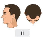 Norwood-Hamilton scale stage 2