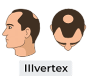 Norwood-hamilton scale stage 3 vertex