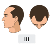 Norwood-hamilton scale stage 3