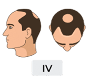 Norwood-hamilton scale stage 4