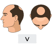 Norwood-hamilton scale stage 5