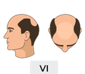 Norwood-hamilton scale stage 6