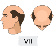 Norwood-hamilton scale stage 7