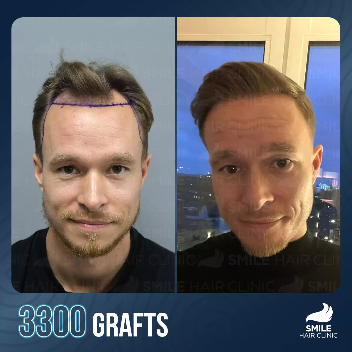 hair transplant turkey before after