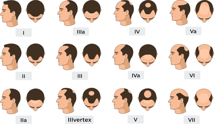 Norwood-Hamilton Scale - Smile Hair Clinic