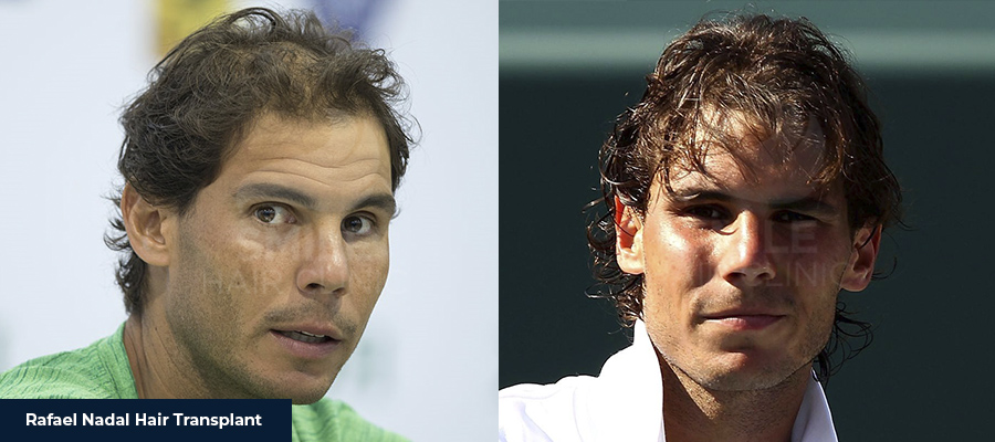 Rafael Nadal hair transplant before and after