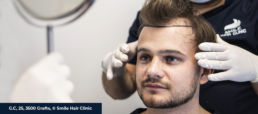 Hair Transplant Turkey Before After - Smile Hair Clinic