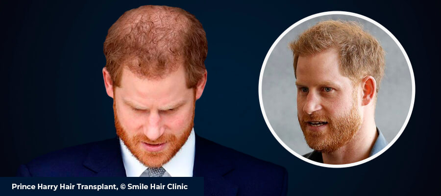 All About Prince Harry Hair Transplant - Smile Hair Clinic