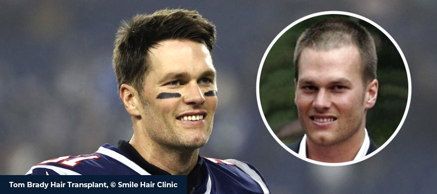 Tom Brady Hair Transplant - Smile Hair Clinic