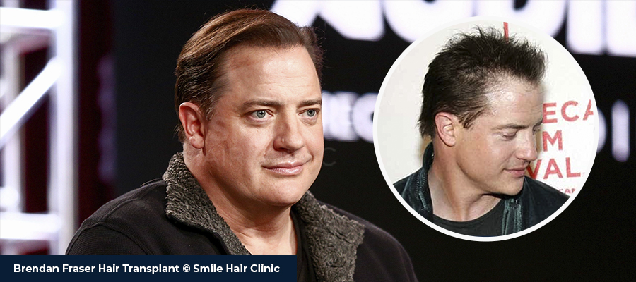Brendan Fraser Hair Transplant - Smile Hair Clinic