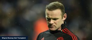 Wayne Rooney After Hair Transplant