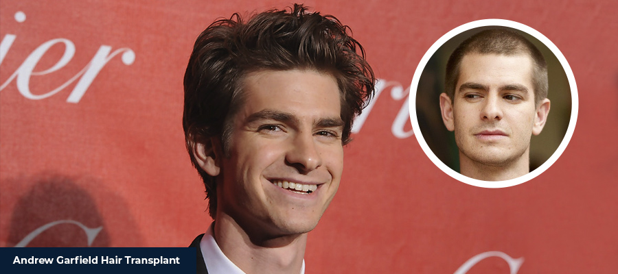 Andrew Garfield hair transplant before and after