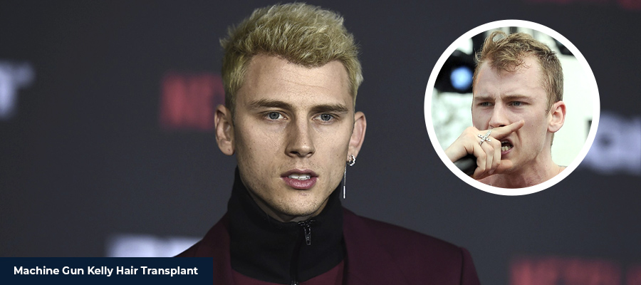 Machine Gun Kelly hair transplant before and after