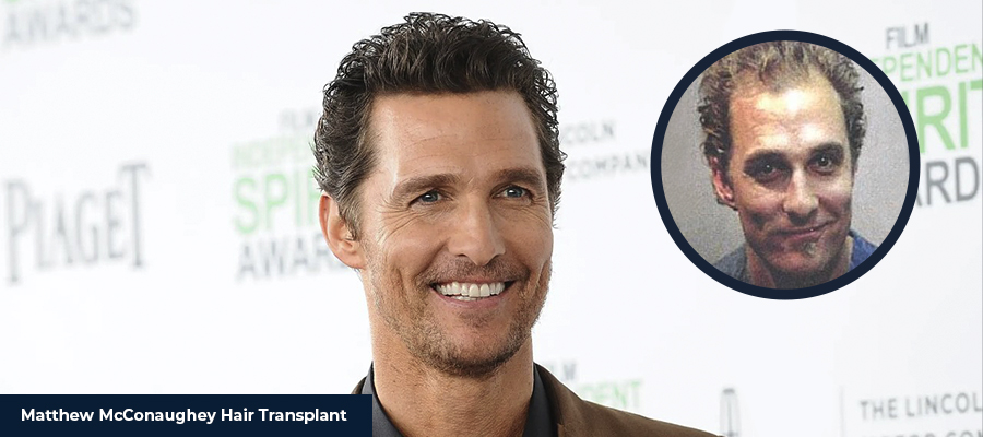 Matthew McConaughey Hair Transplant - Smile Hair Clinic
