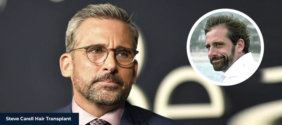 Steve Carell's hair transplant