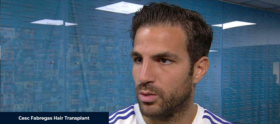 Cesc Fabregas Hair Transplant