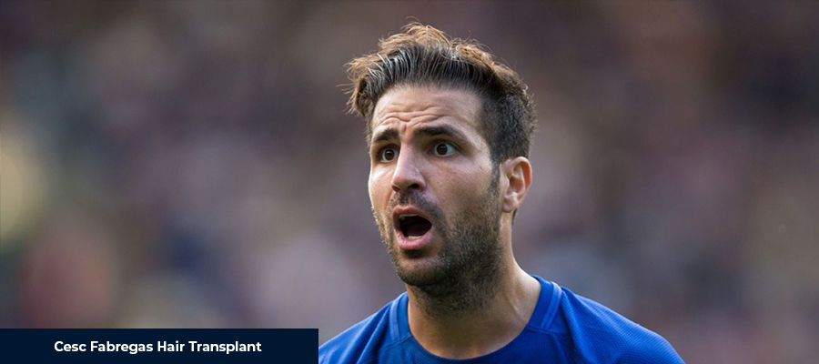 Cesc Fabregas Hair Transplant