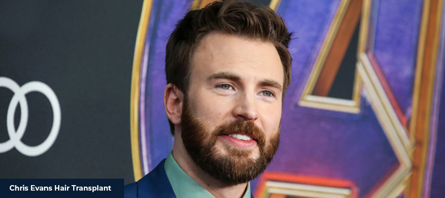 Chris Evans Hair Transplant