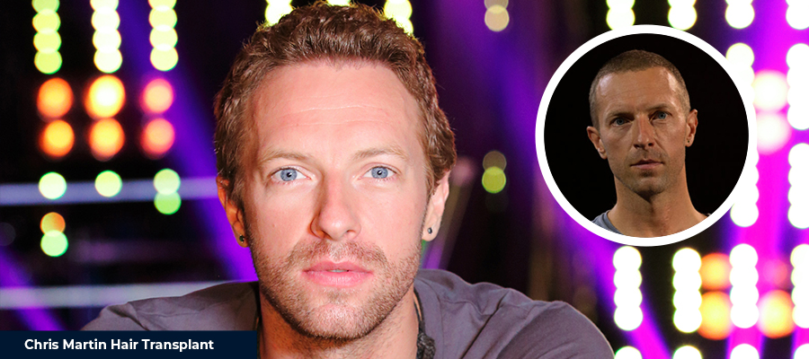 Chris Martin Before After