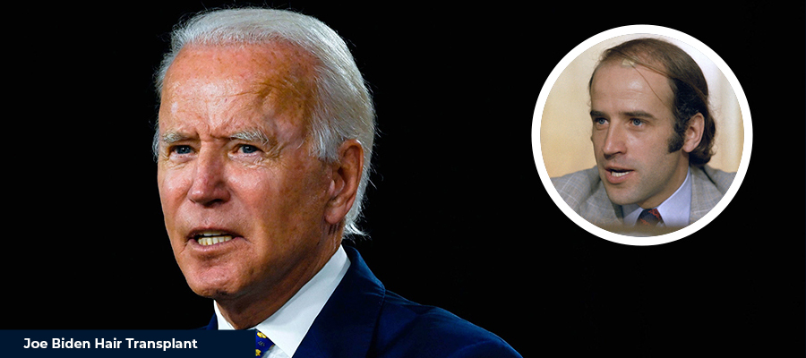 Joe Biden Hair Transplant - Smile Hair Clinic