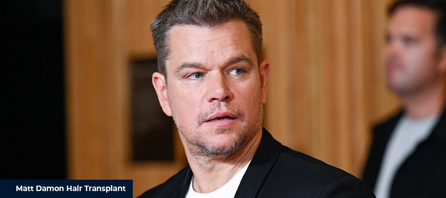 Matt Damon Hair Transplant