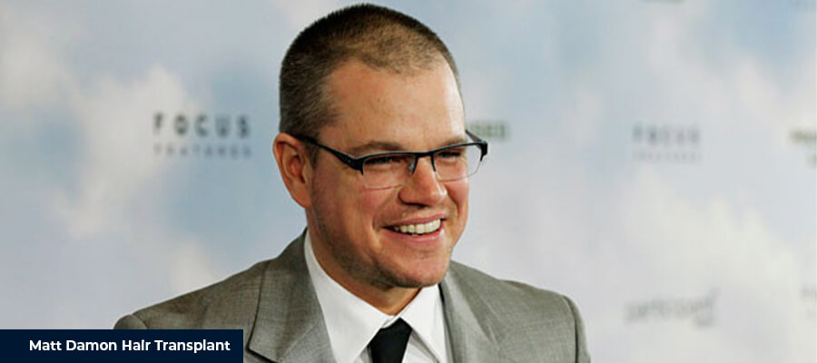 Matt Damon Hair Transplant