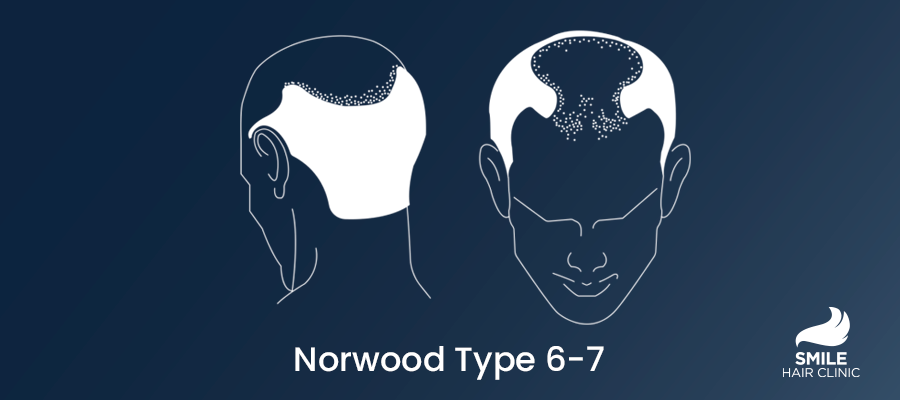 Norwood 6-7 type hair loss