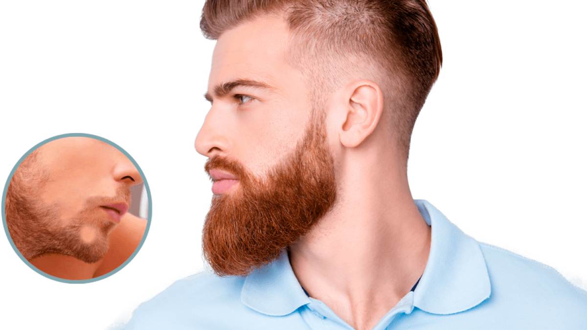 beard transplant in Turkey