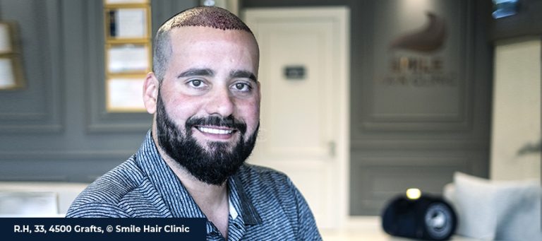 After Hair Transplant