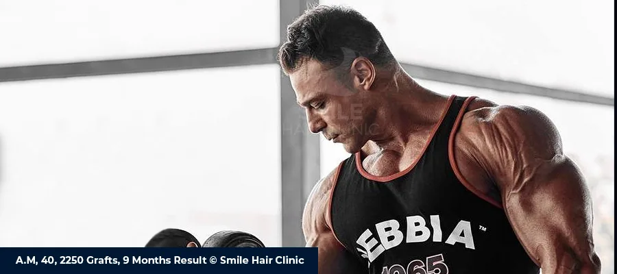 After Hair Transplant