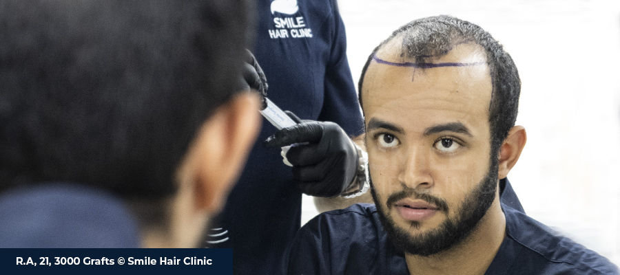 Before Hair Transplant