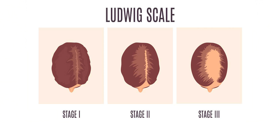 The Causes, Diagnosis and Treatments of Female Hair Loss 1 The Causes, Diagnosis and Treatments of Female Hair Loss