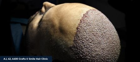 EFFECT OF THE NUMBER OF GRAFT